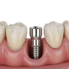 Close up of a dental implant screw placed in a gum line between teeth isolated on transparent background