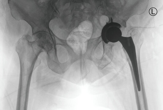 Hip X-ray radiograph showing total hip replacement with prosthetic implant, femoral stem, and acetabular component in pelvis. Medical imaging for post-operative assessment and orthopedic joint.