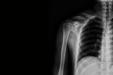 Shoulder X-ray radiograph showing humerus, scapula, clavicle, and glenohumeral joint anatomy....