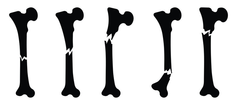 Detailed anatomy and types of bone fractures infographic for medical and healthcare design.