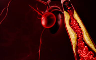 Concept of fast food, sugar, and alcohol leading to atherosclerosis, LDL cholesterol buildup, clogged arteries, cardiovascular disease, stroke, and fatal heart attacks in the human body system. 