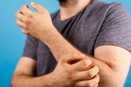 Person scratching arm, close-up. Itchy skin on arm, allergic reaction, dermatitis, eczema, or skin condition. Medical concept, healthcare proble