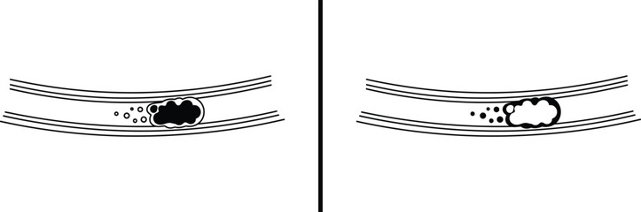 Embolism in Blood Vessel Icon &ndash; Artery Blockage and Clot Illustration