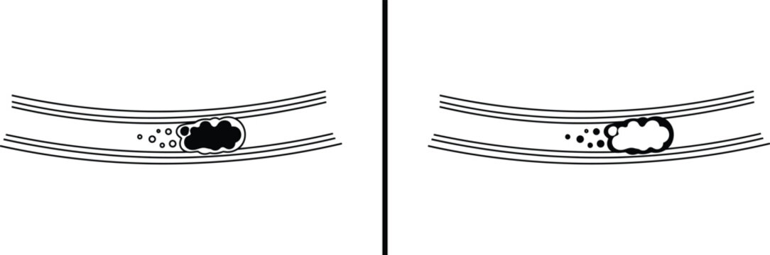 Embolism in Blood Vessel Icon &ndash; Artery Blockage and Clot Illustration