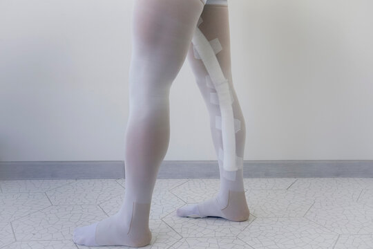 Man legs, bandaged along saphenous vein and wearing white compression garments and tights, are examined by a surgeon in a hospital after surgery, with one leg in front of the other, stepping forward. - Powered by Adobe