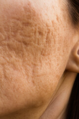 Facial skin with post-acne scars and uneven texture
