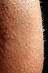 Macro of goosebumps on human skin under warm light
