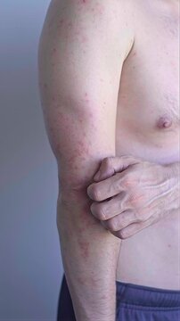 Man with skin irritation and inflammation after chemical exposure redness itching and peeling signs of contact dermatitis