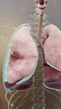 Hemothorax, Normal lung versus collapsed, symptoms of Hemothorax, pleural effusion, empyema, complications after a chest injury, air in the pleural space, 3d Render