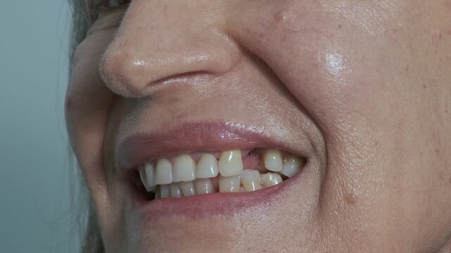 Loss of a dental implant. A woman's mouth with a missing dental crown that broke off from the implant. Metal remains are visible. Concept of the reliability and longevity of implants.