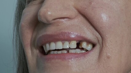 Loss of a dental implant. A woman's mouth with a missing dental crown that broke off from the implant. Metal remains are visible. Concept of the reliability and longevity of implants.