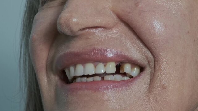 Loss of a dental implant. A woman's mouth with a missing dental crown that broke off from the implant. Metal remains are visible. Concept of the reliability and longevity of implants.