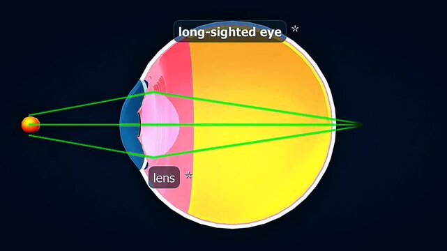 long-sightedness or hyperopia.