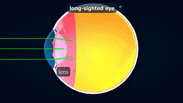 Long sighted eye