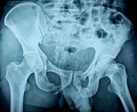 X Ray Hip showing Pelvic bone fracture 