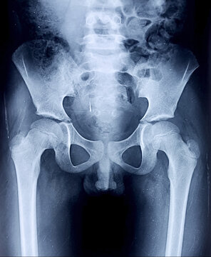 Xray Hip showing Acetabulum fracture Of Both sides