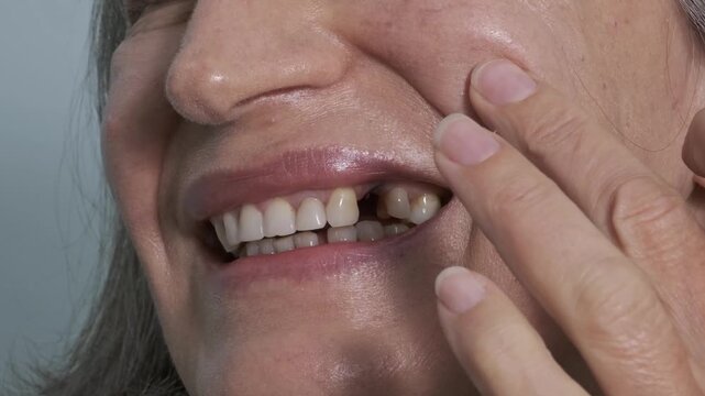 Loss of a dental implant. A woman's mouth with a missing dental crown that broke off from the implant. Metal remains are visible. Concept of the reliability and longevity of implants.