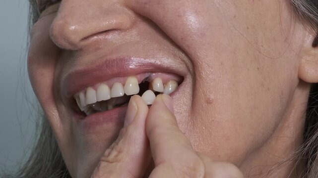 Loss of a dental implant. A woman's mouth with a missing dental crown that broke off from the implant. Metal remains are visible. Concept of the reliability and longevity of implants.