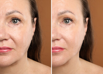 Woman before and after anti-aging treatment on brown background, closeup. Collage showing skin...