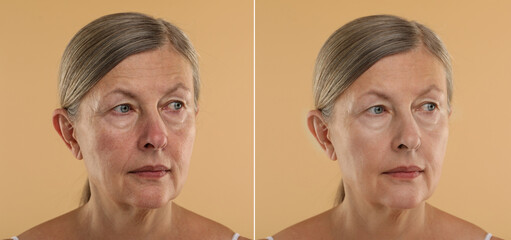 Woman before and after anti-aging treatment on beige background, closeup. Collage showing skin...