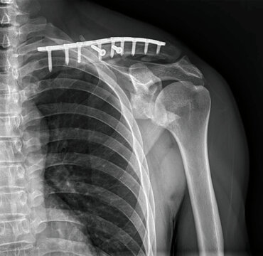 Clavicle X-ray radiograph showing collarbone fracture with surgical plate and screws fixation. Medical imaging for post-operative assessment of shoulder girdle, ribs, and orthopedic hardware placement