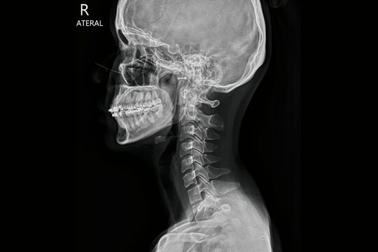 Lateral skull and cervical spine X-ray radiograph showing cranium, jaw with dental braces, neck vertebrae, and upper spine anatomy. Medical diagnostic imaging for orthodontic evaluation, skeletal. - Powered by Adobe