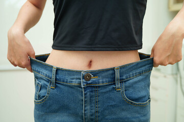 Asian woman with cellulite on leg skin fat, overweight problem.