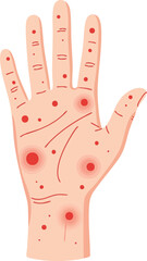 Flat illustration showing a human hand with widespread red rash spots, ideal for topics in dermatology, skin disease, infection, allergy, or symptom education