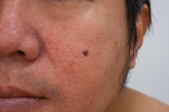 Facial skin with redness, moles, and skin tags&mdash;ideal for dermatology ads. Highlights treatable conditions with copy space for your project.