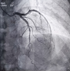 Coronary angiogram of left coronary artery during cardiac catheterization with contrast dye. Abnormal findings. Colour adjust, AP Cranial view.