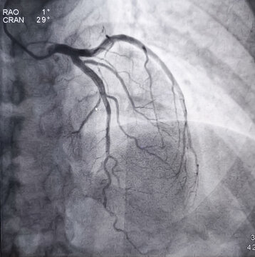 Coronary angiogram of left coronary artery during cardiac catheterization with contrast dye. Abnormal findings. Colour adjust, AP Cranial view.