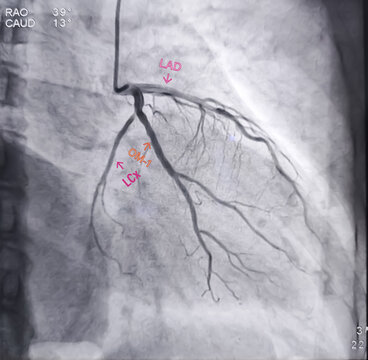 Coronary angiogram of left coronary artery during cardiac catheterization with contrast dye. Abnormal findings. Colour adjust