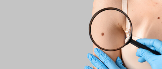 Dermatologist with magnifier examining moles on woman's shoulder against grey background, closeup
