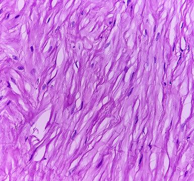 Microscopic image of seminiferous tubules showing atrophic changes, Sartoli cell are hyperplastic.