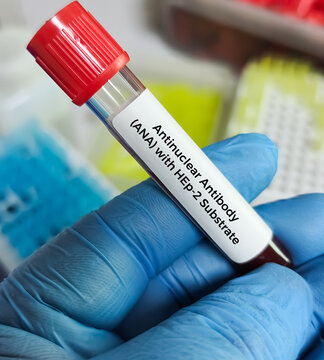 Blood sample for Antinuclear Antibody (ANA) With HEp-2 Substrate test, autoimmune disease diagnosis.