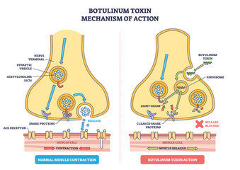 Botulinum toxin mechanism illustration shows a nerve terminal blocking acetylcholine release, key objects, synaptic vesicles, SNARE proteins, ACh receptor, transparent background.