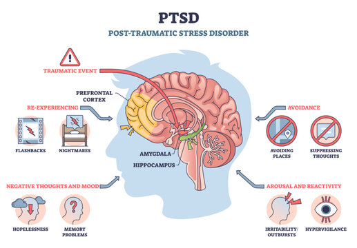 PTSD brief diagram shows trauma s effects on the brain, spotlighting amygdala and hippocampus, with flashbacks, avoidance, and hypervigilance, transparent background. Brain, amygdala, hippocampus.