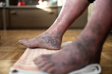 This image presents a detailed view of swollen feet positioned on a towel, illustrating the impact of edema alongside natural lighting and domestic textures in the background.