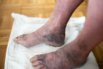 The photograph features feet affected by edema placed gently on a soft towel, showcasing a serene home setting while drawing attention to the details of composition and skin texture.