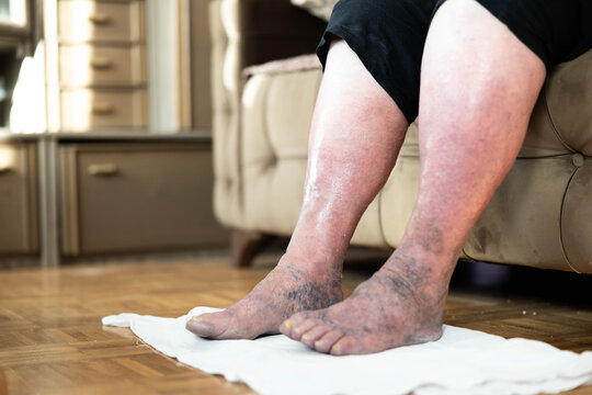 In this photo, feet suffering from edema are displayed against a cozy home backdrop, emphasizing the emotional weight of discomfort amidst familiar domestic surroundings.