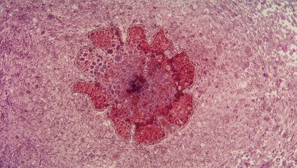Pathological examination of basal cell carcinoma through skin biopsy. The prevalent form of skin cancer caused by UV exposure. Consistent application of sunscreen helps in prevention.