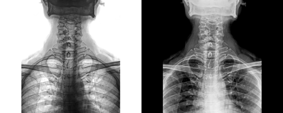 Neck Anterior View X-Ray Image Displaying Cervical Vertebrae for Detection of Dislocations, and Structural Abnormalities Isolated on Transparent Background
