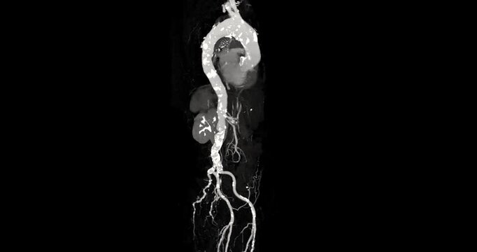 CTA whole aorta showing aortic aneurysm with contrast enhancement. High-quality radiologic image demonstrating vascular abnormality and advanced diagnostic imaging technology.