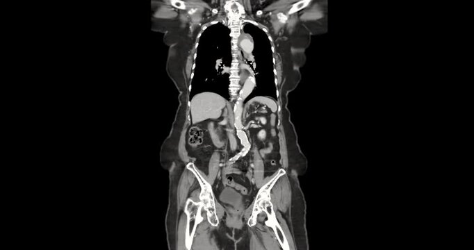 CTA whole aorta showing aortic aneurysm with contrast enhancement. High-quality radiologic image demonstrating vascular abnormality and advanced diagnostic imaging technology.