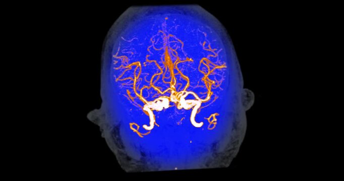 Magnetic resonance angiography of the brain shows detailed cerebral arteries. Advanced imaging technology supports precise radiology diagnosis. Useful for medical education and research.