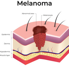 Melanoma Skin Cancer Progression Diagram