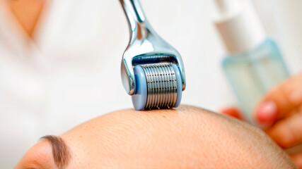 Close-up of a derma roller microneedling treatment on a person's forehead.