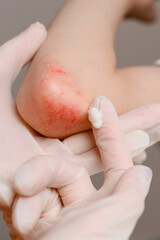 Treatment of childhood injuries using gentle cleansing, application medicinal ointment by doctor wearing gloves. Provision of antiseptic care for contact dermatitis, eczema, allergic skin scratches.