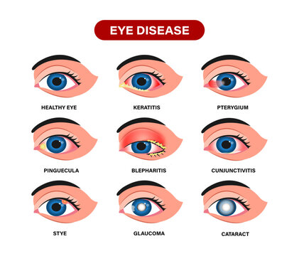 Surfer&rsquo;s Eye (Pterygium) With Red and Irritated Pink Eye