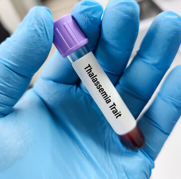Blood sample for Electrophoresis test. Diagnosis of Thalassemia (alpha or beta)